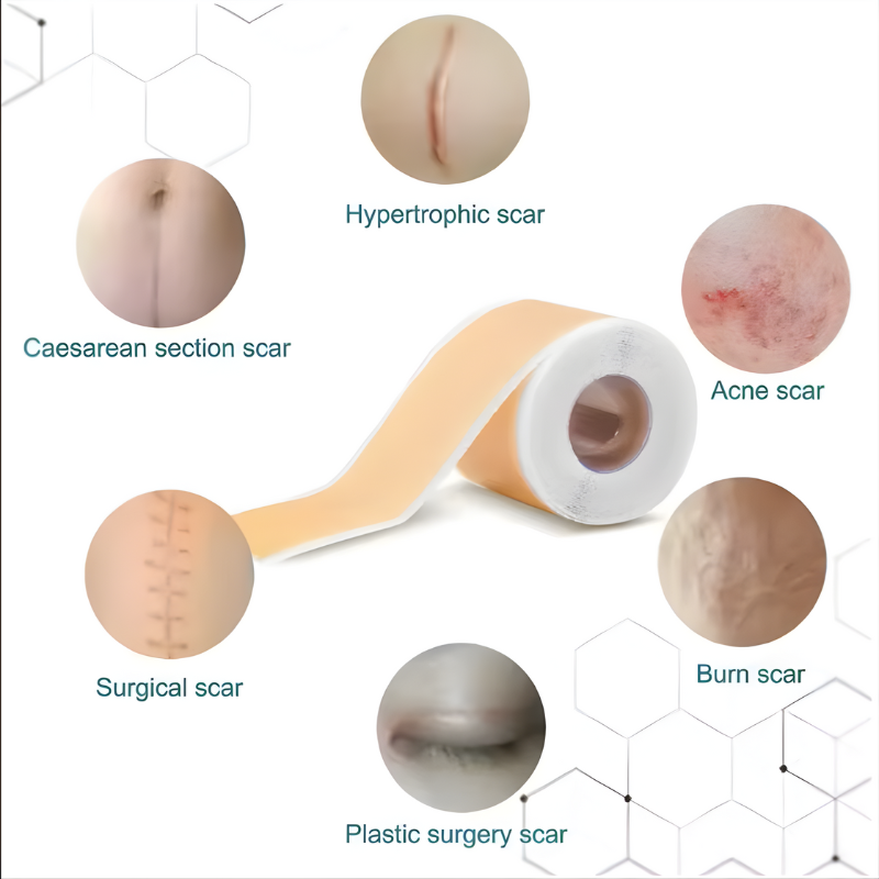 ScarEase™ Gel Repair Patch
